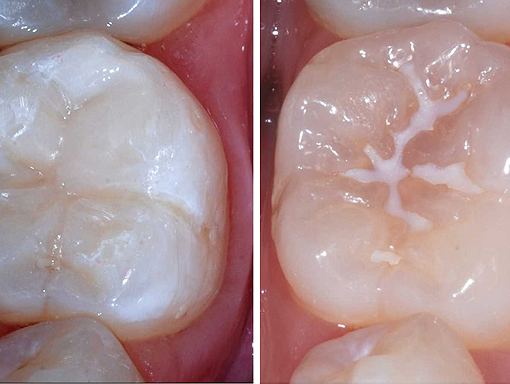 Pit and Fissure Sealants