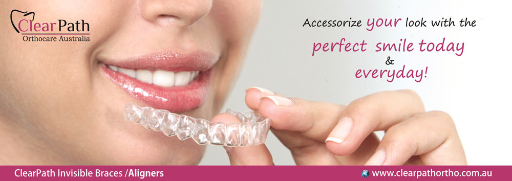 Clearpath Aligners
