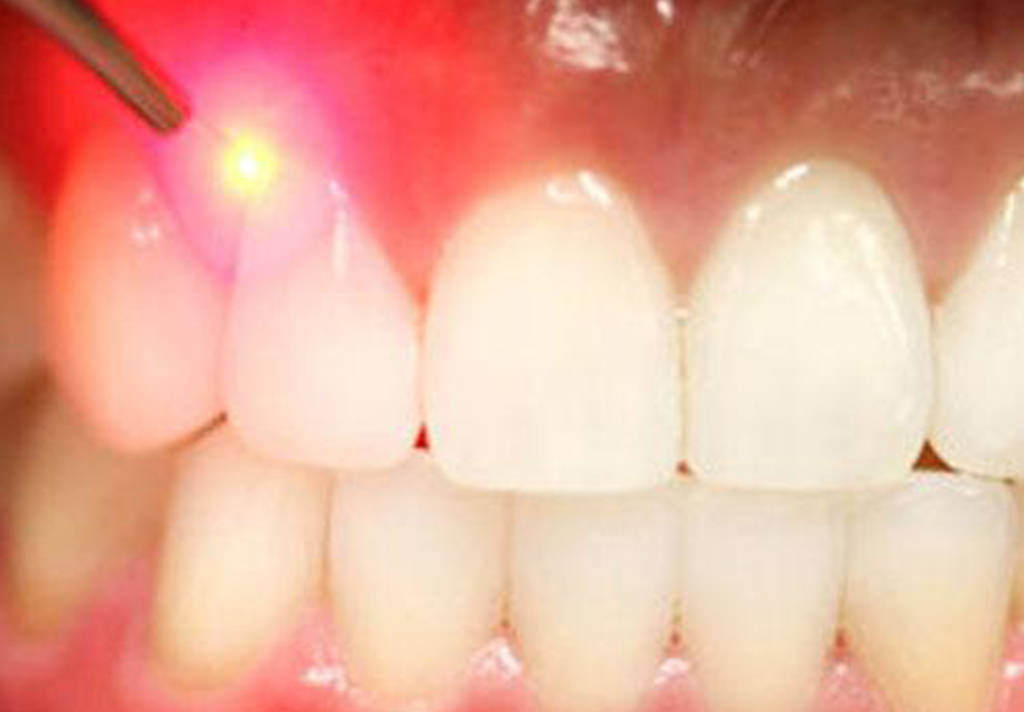 >Laser Gum Treatment