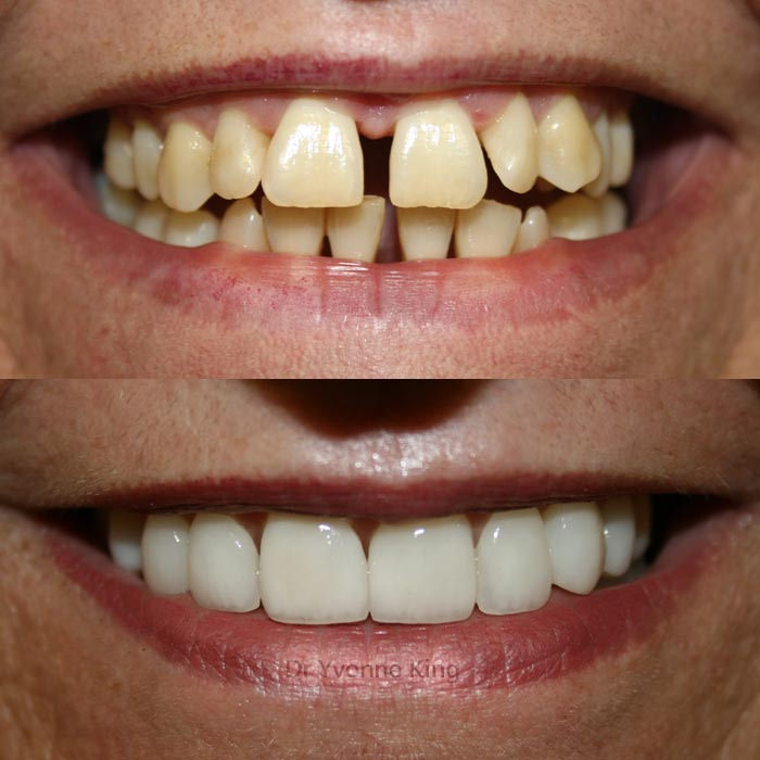 Veneers