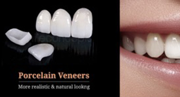 Looking for a Smile makeover? Veneers is the answer