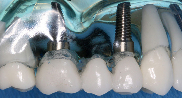Will Dental Implants Help You?