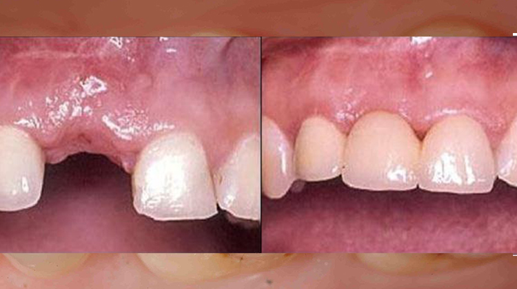 Do you want to know more about dental Crowns and Bridges?